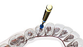 Root canal treatment, illustration