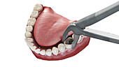 Tooth extraction, illustration