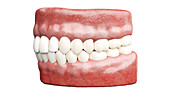 Dental veneers, illustration