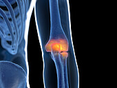 Inflamed elbow joint, illustration