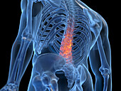 Inflamed back, illustration