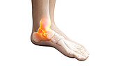Painful ankle joint, illustration