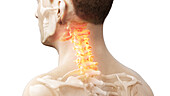 Painful cervical spine, illustration