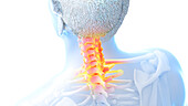 Painful cervical spine, illustration