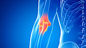 Painful elbow joint, illustration