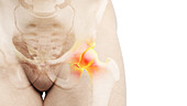 Painful hip joint, illustration