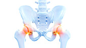 Painful hip joints, illustration