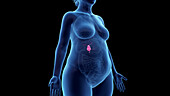 Obese woman's gallbladder, illustration