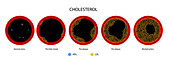 Cholesterol in human blood vessels, illustration