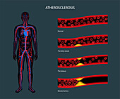 Atherosclerosis, illustration