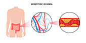 Mesenteric ischaemic, illustration