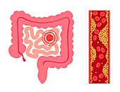 Mesenteric ischaemic, illustration