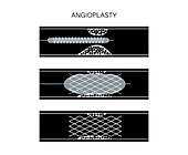 Angioplasty, illustration