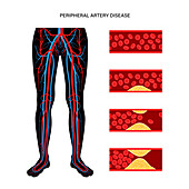 Peripheral artery disease, illustration