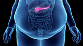 Obese man's pancreas, illustration