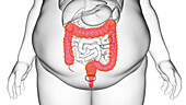 Obese man's colon, illustration