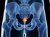 Inflamed coccyx, illustration