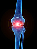 Painful knee joint, illustration