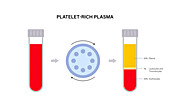 Platelet rich plasma preparation, illustration