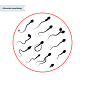 Abnormal sperm, illustration