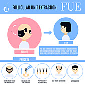 FUE hair transplantation in men, illustration