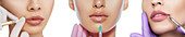Lip augmentation injections