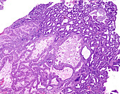 Atypical endometrial hyperplasia, light micrograph