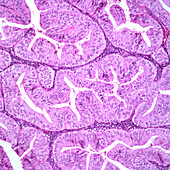 Endometrioid carcinoma, grade 1, light micrograph