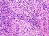 Endometrioid carcinoma, grade 3, light micrograph