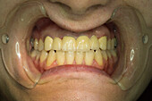 Cosmetic restoration of tooth