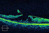 Vitreomacular traction, OCT scan