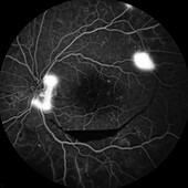 Retina damage from diabetes, angiogram