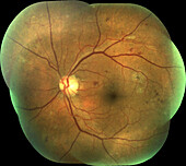 Retina damage from diabetes, fundoscopy
