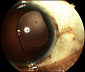Intraocular lens subluxation
