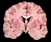 Human brain, gross specimen