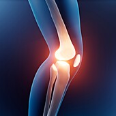 Knee joint injury, illustration