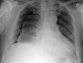 Pneumothorax, X-ray
