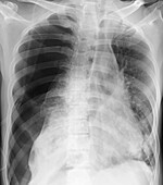 Pneumothorax, X-ray