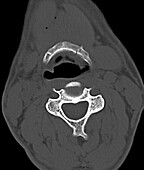 Fractured hyoid bone, CT scan