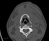 Fractured hyoid bone, CT scan