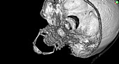 Fractured hyoid bone, 3D CT scan