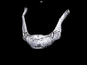 Fractured hyoid bone, 3D CT scan