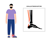 Achilles tendon injury, illustration