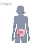 Inflamed appendix, conceptual illustration