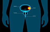 Bladder cancer stages, illustration