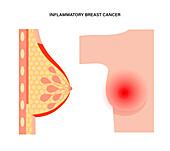 Inflammatory breast cancer, illustration