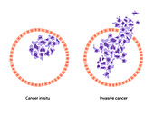 Cancer in situ and invasive cancer, illustration