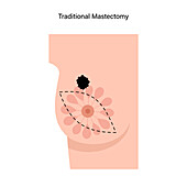 Traditional female mastectomy, illustration