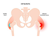 Hip bursitis, conceptual illustration