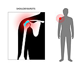 Shoulder bursitis, conceptual illustration
